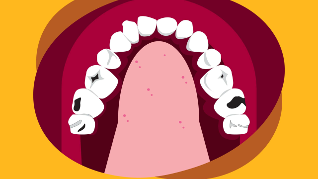 6 Penyebab Gigi Berlubang yang Sering Diabaikan dan Sangat Fatal