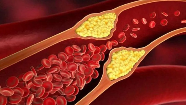 Cara Alami Menurunkan Kolesterol Jahat Secara Alami Tanpa Ketergantungan Obat